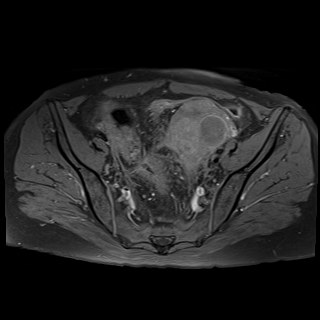 Bilateral tubo-ovarian abscesses (Radiopaedia 58635-65829 Axial T1 fat sat 16).jpg