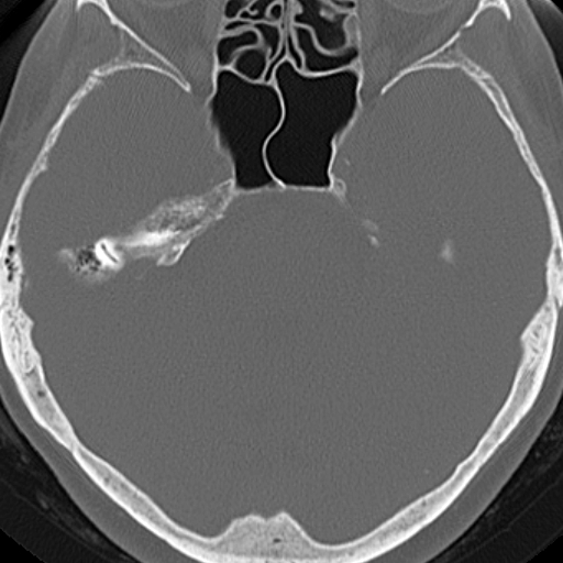 File:Bilateral tympanoplasty (Radiopaedia 16947-16664 Axial bone window 4).jpg