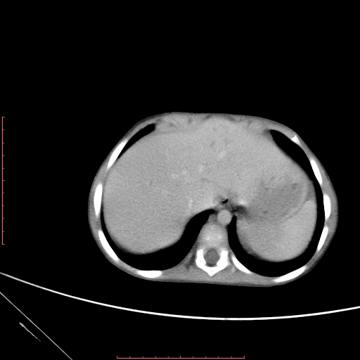 Biliary tract embryonal rhabdomyosarcoma (Radiopaedia 51815-57648 A 2).jpg