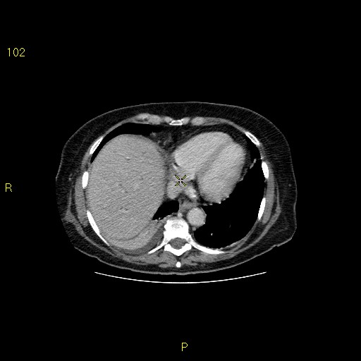 File:Biloma with drainage into the colon (Radiopaedia 20032-20068 A 15).jpg
