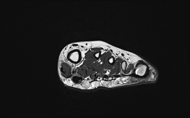 Bipartite hallux sesamoid diastasis (Radiopaedia 77133-89109 Coronal PD 22).jpg