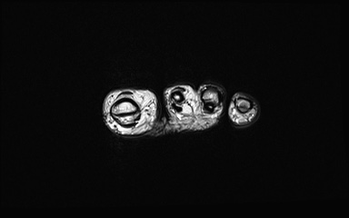 File:Bipartite hallux sesamoid diastasis (Radiopaedia 77133-89109 Coronal PD 42).jpg