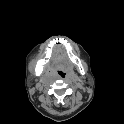 Bisphosphonate-related osteonecrosis of the jaw (Radiopaedia 71324-81642 non-contrast 63).jpg