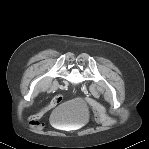 File:Bladder papillary urothelial carcinoma (Radiopaedia 48119-52951 Axial C+ delayed 42).png