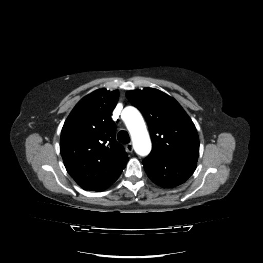 File:Bladder tumor detected on trauma CT (Radiopaedia 51809-57609 A 34).jpg
