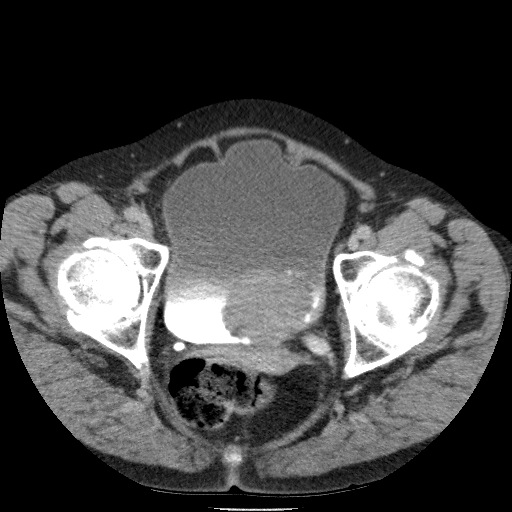 Bladder tumor detected on trauma CT (Radiopaedia 51809-57609 C 129).jpg