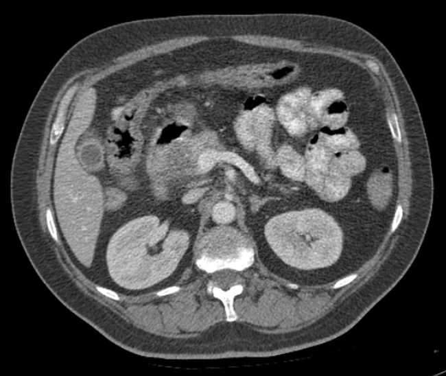 File:Bleeding duodenal ulcer and adenomyomatosis of gallbladder (Radiopaedia 61834-69861 A 40).jpg
