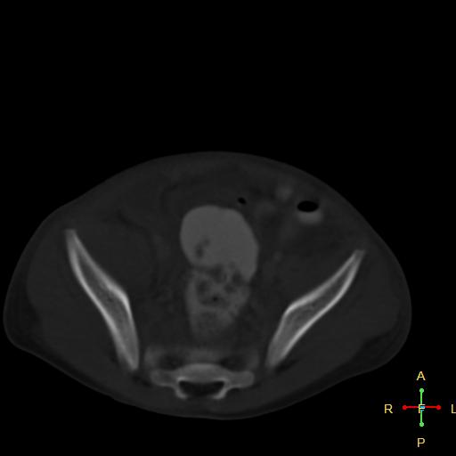 File:Blunt abdominal trauma (Radiopaedia 24780-25044 Axial bone window 11).jpg