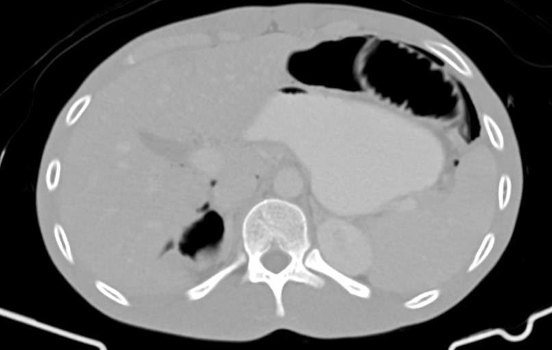 Blunt injury to the small bowel (Radiopaedia 74953-85987 Axial Wide 15).jpg