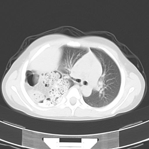 File:Bochdalek diaphragmatic hernia (Radiopaedia 38866-41059 Axial lung window 9).jpg