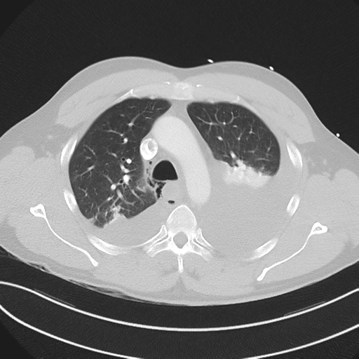 Boerhaave syndrome (Radiopaedia 39382-41660 Axial lung window 18).png