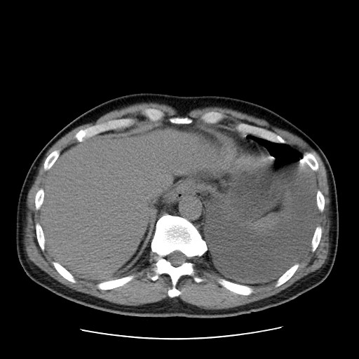 File:Boerhaave syndrome (Radiopaedia 59796-67310 Axial liver window 54).jpg