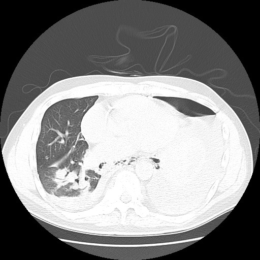 Boerhaave syndrome (Radiopaedia 59796-67310 Axial lung window 41).jpg
