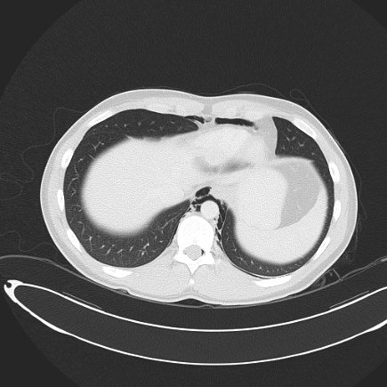 File:Boerhaave syndrome with mediastinal, axillary, neck and epidural free gas (Radiopaedia 41297-44115 Axial lung window 72).jpg