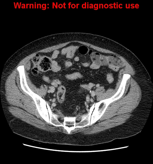 File:Bosniak renal cyst - type II (Radiopaedia 23404-23468 F 51).jpg