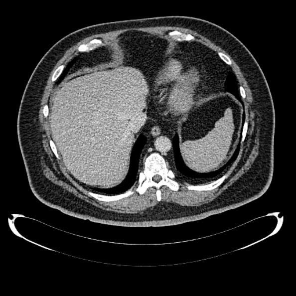 File:Bosniak renal cyst - type IV (Radiopaedia 24244-24518 C 28).jpg