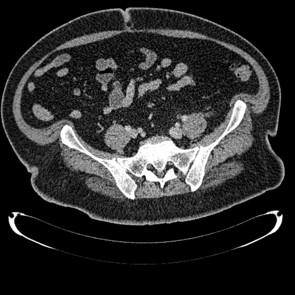 Bosniak renal cyst - type IV (Radiopaedia 24244-24518 C 291).jpg