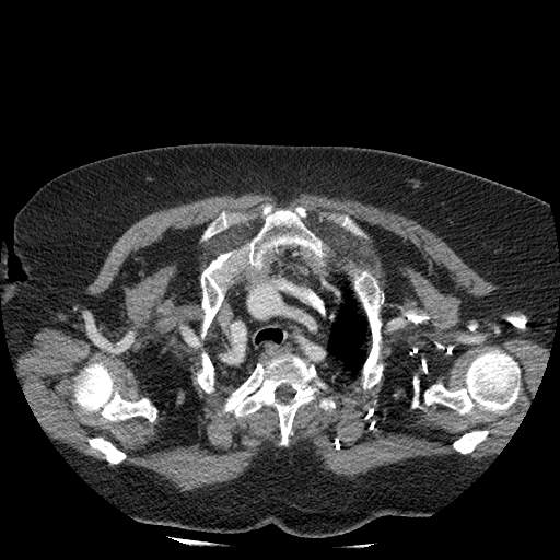 Bovine aortic arch - right internal mammary vein drains into the superior vena cava (Radiopaedia 63296-71875 A 20).jpg