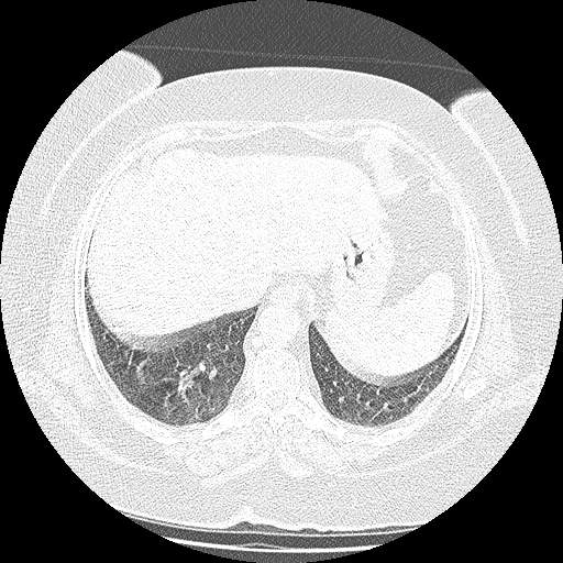 Bovine aortic arch - right internal mammary vein drains into the superior vena cava (Radiopaedia 63296-71875 Axial lung window 136).jpg
