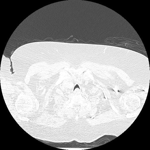 Bovine aortic arch - right internal mammary vein drains into the superior vena cava (Radiopaedia 63296-71875 Axial lung window 7).jpg