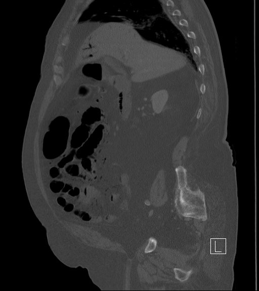 File:Bowel ischemia secondary to SMA occlusion with extensive portomesenteric venous gas (Radiopaedia 54656-60871 Sagittal bone window 74).jpg
