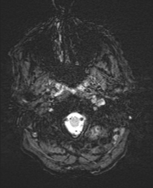 Brain metastases - lung cancer primary (Radiopaedia 75060-86115 Axial SWI 5).jpg