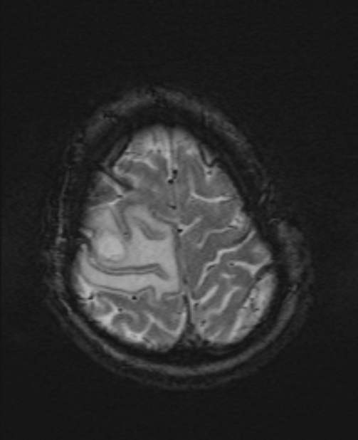 Brain metastases - lung cancer primary (Radiopaedia 75060-86115 Axial SWI 53).jpg