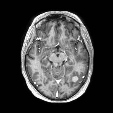 Brain metastases from lung cancer (Radiopaedia 83839-99028 Axial T1 C+ 25).jpg