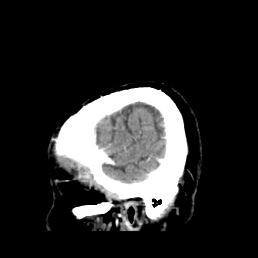 Brain metastasis (Radiopaedia 42617-45760 D 53).jpg