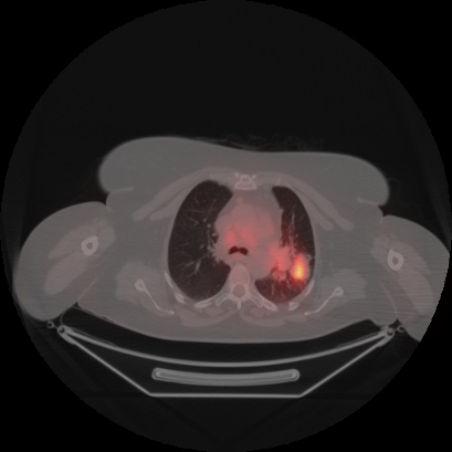 Brain metastasis (Radiopaedia 89847-106962 Axial lung window 18).jpg