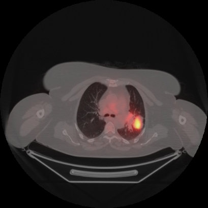 Brain metastasis (Radiopaedia 89847-106962 Axial lung window 19).jpg