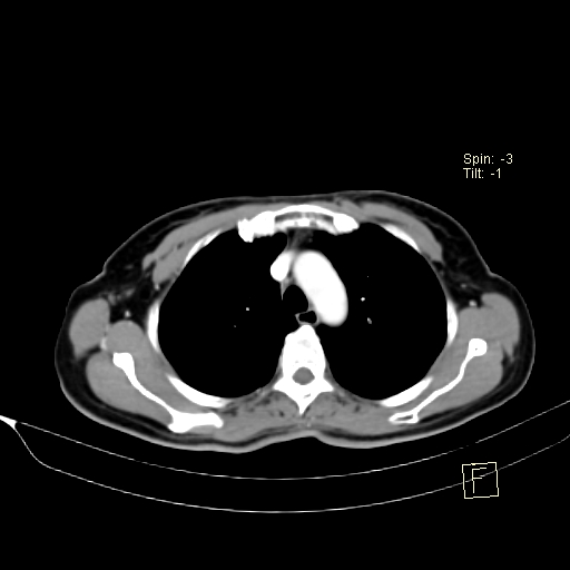 Brain metastasis as initial presentation of non-small cell lung cancer (Radiopaedia 65122-74127 A 14).jpg