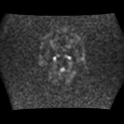 File:Brainstem glioma (Radiopaedia 30923-31624 Axial DWI 1).jpg