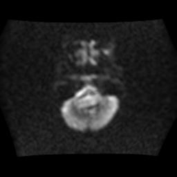 File:Brainstem glioma (Radiopaedia 30923-31624 Axial DWI 4).jpg