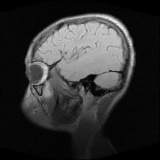 File:Brainstem glioma (Radiopaedia 30923-31624 Sagittal T1 15).jpg