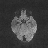 Brainstem glioma (Radiopaedia 67531-76922 Axial DWI 56).jpg