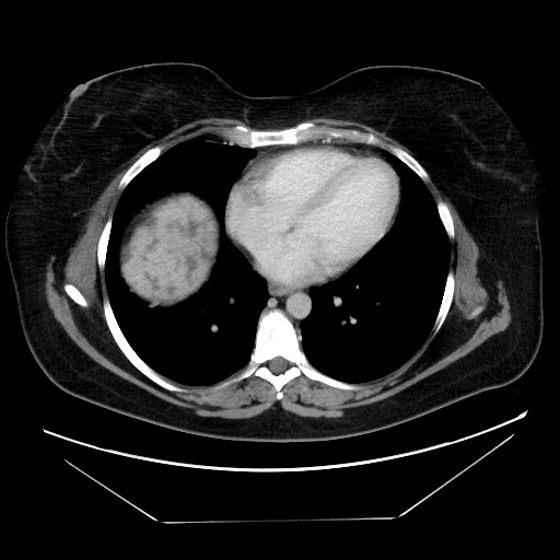 Breast cancer pseudocirrhosis after chemotherapy (Radiopaedia 65407-74457 A 6).jpg