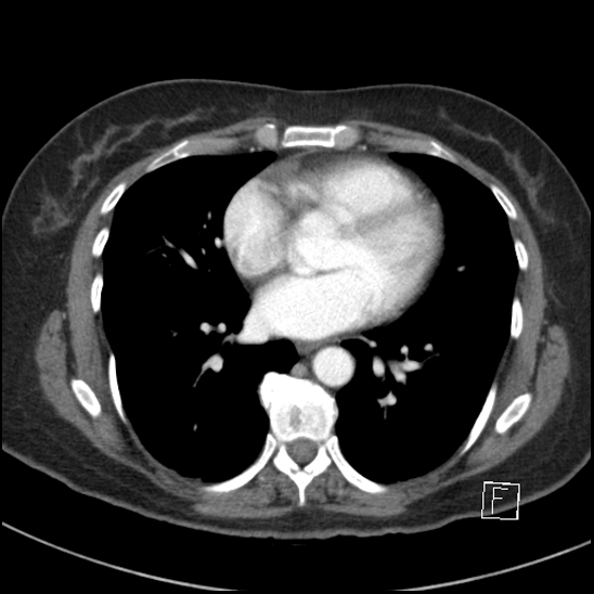 Breast metastases from renal cell cancer (Radiopaedia 79220-92225 A 56).jpg