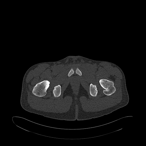 Brodie abscess- femoral neck (Radiopaedia 53862-59966 Axial bone window 187).jpg
