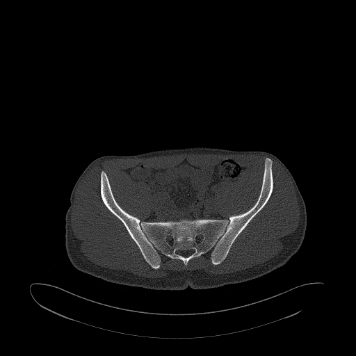Brodie abscess- femoral neck (Radiopaedia 53862-59966 Axial bone window 57).jpg