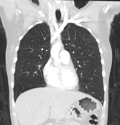 File:Bronchial atresia (Radiopaedia 73677-84470 Coronal lung window 11).jpg