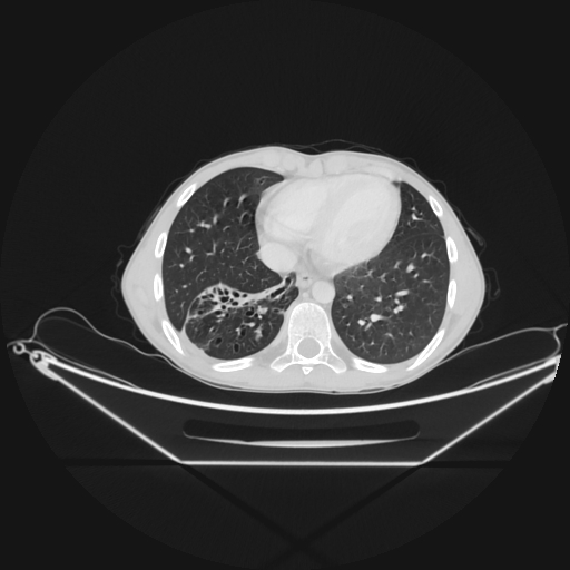 Bronchial carcinoid tumor (Radiopaedia 57187-64090 Axial lung window 60).jpg