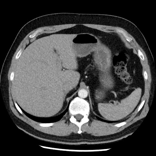 Bronchial carcinoid tumor (Radiopaedia 67377-76764 A 58).jpg