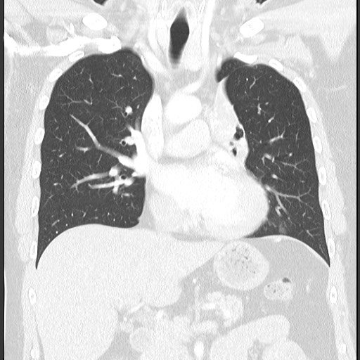Bronchial carcinoid tumor (Radiopaedia 67377-76764 Coronal lung window 33).jpg