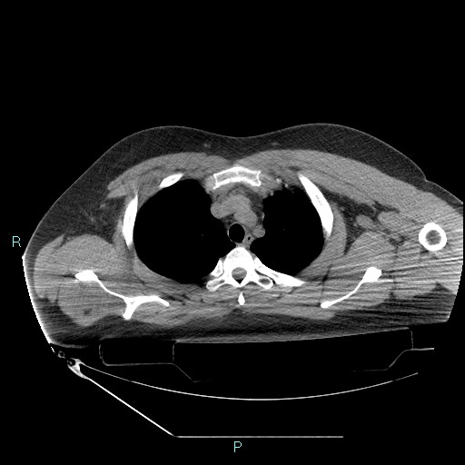 Bronchial carcinoid tumor (Radiopaedia 78272-90870 Axial non-contrast 23).jpg