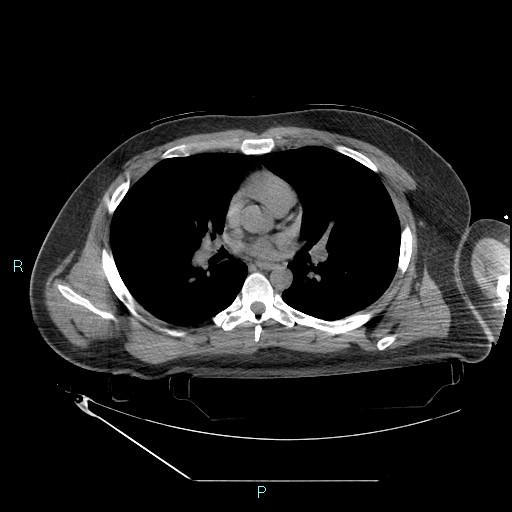 Bronchial carcinoid tumor (Radiopaedia 78272-90870 Axial non-contrast 51).jpg