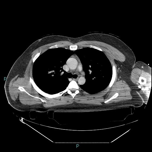 Bronchial carcinoid tumor (Radiopaedia 78272-90870 C 47).jpg