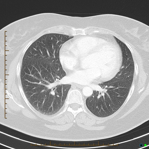 File:Bronchial diverticula (Radiopaedia 79512-92675 Axial lung window 29).jpg