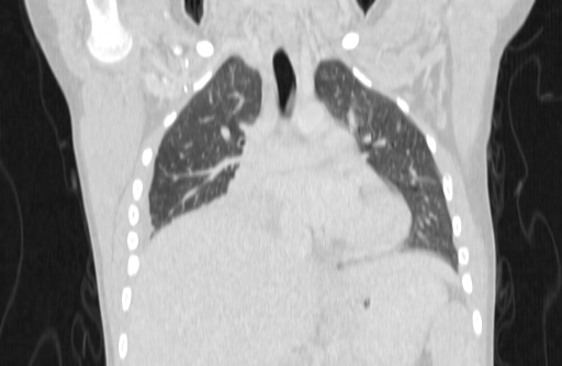 Bronchial mucoepidermoid carcinoma (Radiopaedia 57023-63895 Coronal lung window 6).jpg