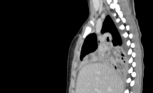 Bronchial mucoepidermoid carcinoma (Radiopaedia 57023-63895 Sagittal 82).jpg